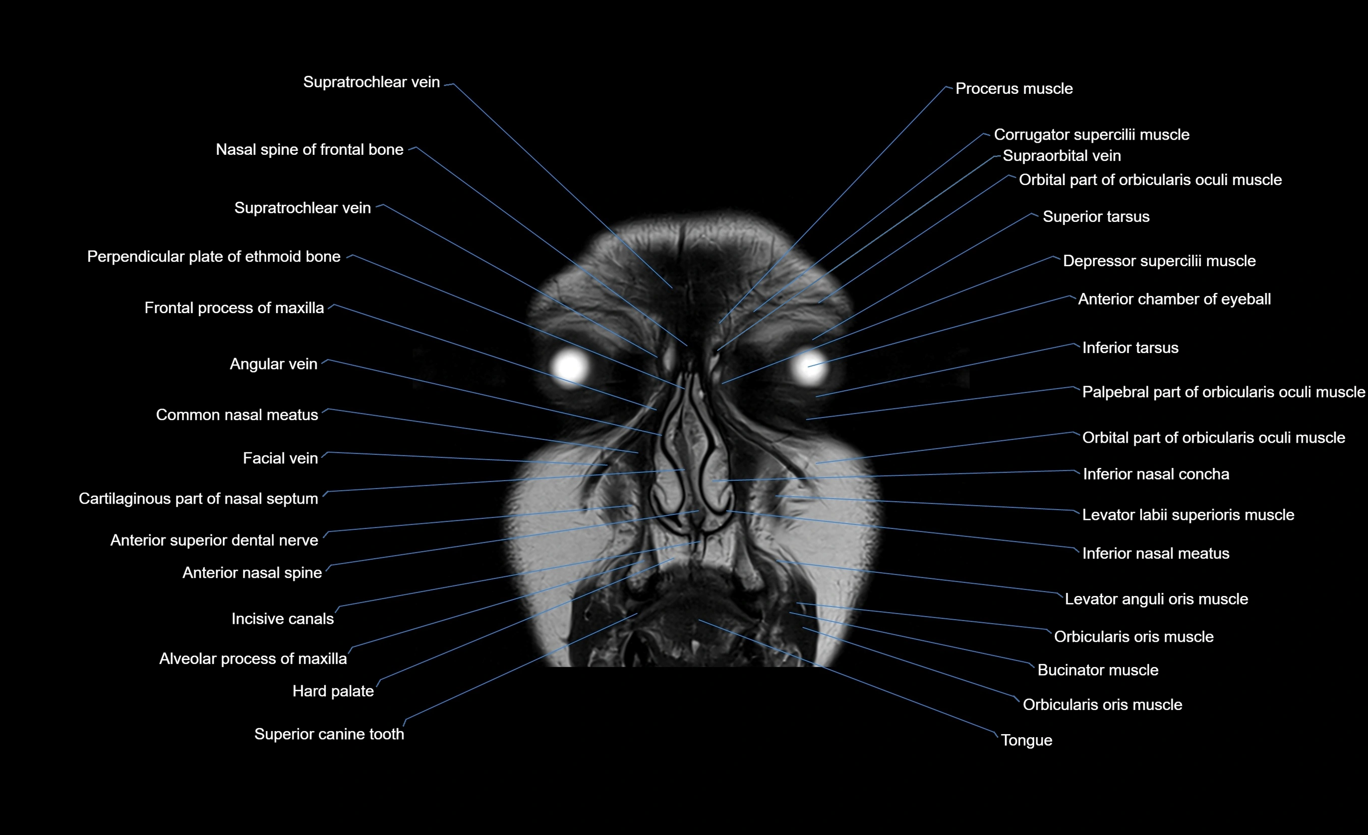 MRI face & paranasal sinuses(PNS) labelled  coronal  cross sectional anatomy 3T radiology  image-img-00001-00013.webp